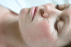acupuncture at pure moves